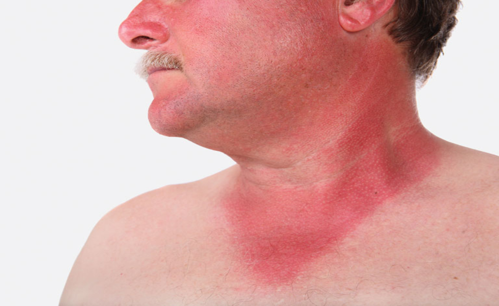 Sunburn and Blue Eyes: Causes, Prevention, and Treatment - wide 3